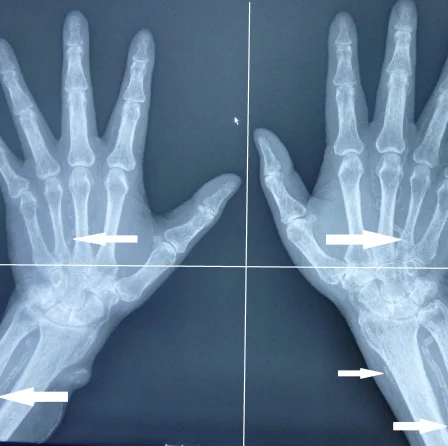 Dorsopalmare Röntgenaufnahme beider Hände und distaler Unterarme nebeneinander, links die linke, rechts die rechte Hand. Weiße Pfeile zeigen auf feine, schienenartige, gewundene Verkalkungslinien entlang der Arterien in der Mittelhand und am Unterarm.