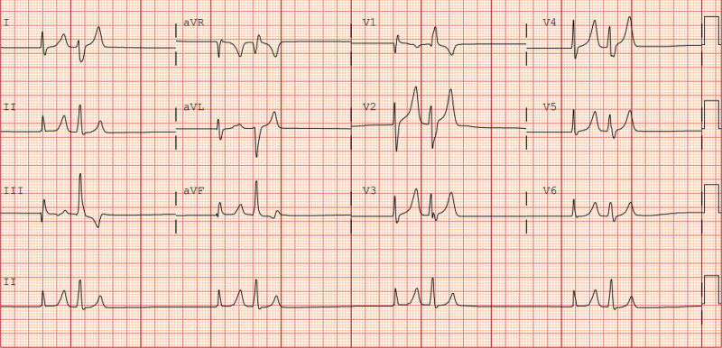 Reales Zwölfkanal-EKG mit Rhythmusstreifen II: schmale Kammerkomplexe, die jeweils paarweise dicht aufeinander folgen, danach eine längere Pause; vor den Komplexen sind keine P-Wellen zu erkennen. In V2, V3 und V4 sind die T-Wellen hoch, spitz und schmalbasig.