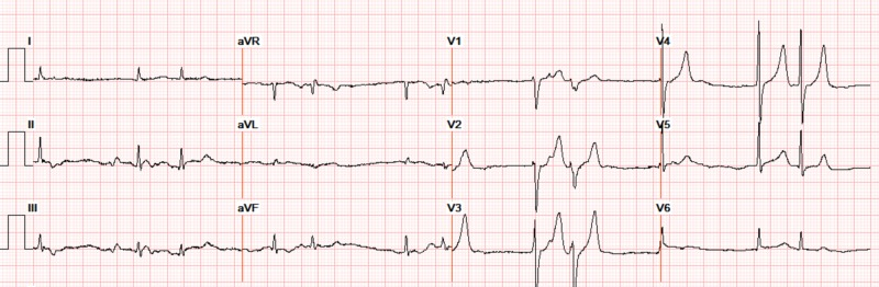 Reales Zwölfkanal-EKG ohne Rhythmusstreifen: langsamer, unregelmäßiger Rhythmus mit schmalen Kammerkomplexen; die Extremitätenableitungen sind niedrig und unruhig. In V2, V3 und V4 sind die T-Wellen hoch und spitz; die Ableitung V3 ist am unteren Bildrand angeschnitten.