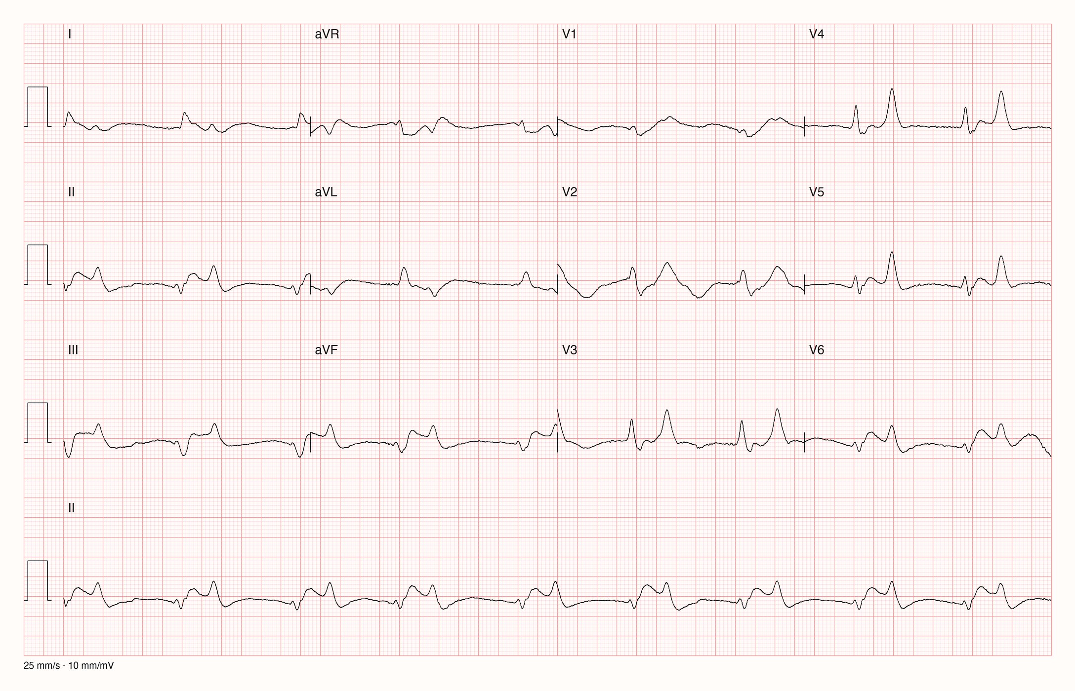Reales Zwölfkanal-EKG mit Rhythmusstreifen II bei 25 mm/s und 10 mm/mV: langsamer Rhythmus um 50/min mit flachen, kaum abgrenzbaren P-Wellen und schmalen Kammerkomplexen. In V2, V3 und V4 sind die T-Wellen hoch, spitz und schmalbasig und überragen den QRS-Komplex.