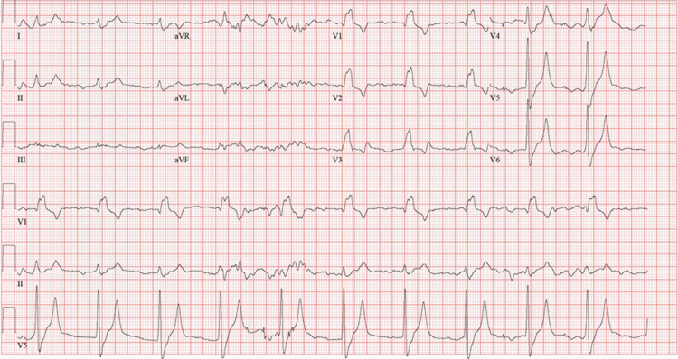 Reales Zwölfkanal-EKG mit Rhythmusstreifen V1, II und V5: regelmäßiger Rhythmus um 60/min mit deutlich verbreiterten Kammerkomplexen; in V1 ist der Komplex M-förmig, in V5 und V6 endet er mit einer breiten S-Zacke. Die T-Wellen in V4 bis V6 sind hoch und spitz; die Extremitätenableitungen sind niedrig und unruhig.