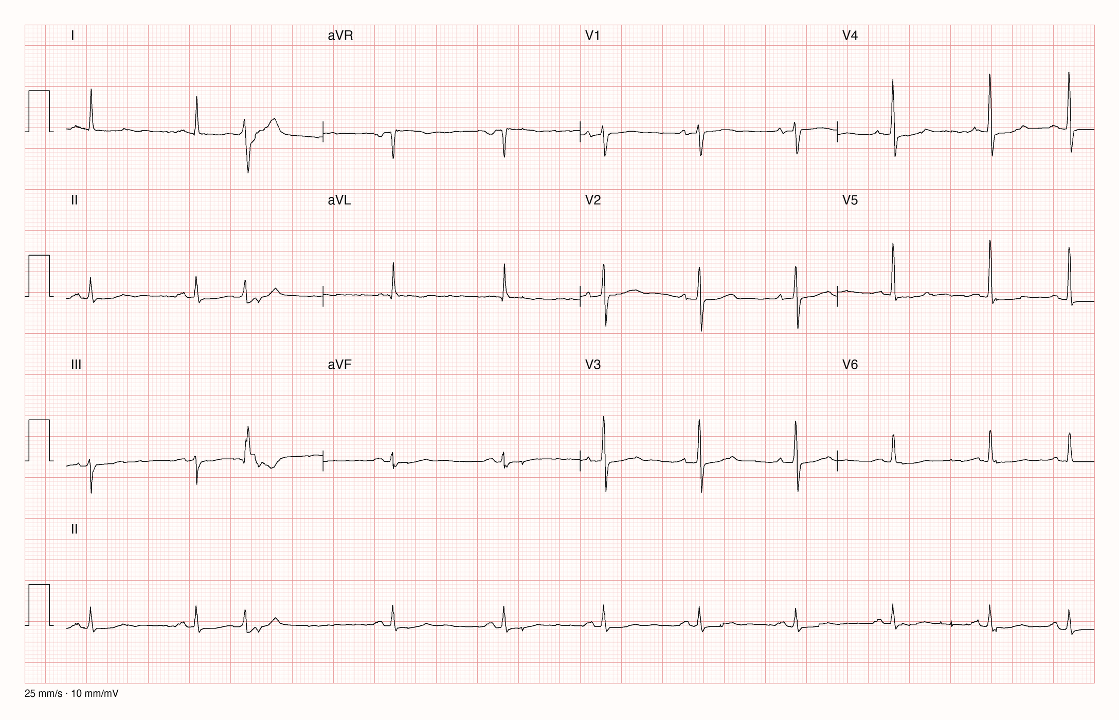 Reales Zwölfkanal-EKG mit Rhythmusstreifen II bei 25 mm/s und 10 mm/mV: überwiegend regelmäßiger Rhythmus um 60/min mit P-Wellen vor schmalen QRS-Komplexen; der dritte Schlag kommt vorzeitig, ist breiter und anders geformt und wird von einer längeren Pause gefolgt. Die T-Wellen sind in fast allen Ableitungen sehr flach.