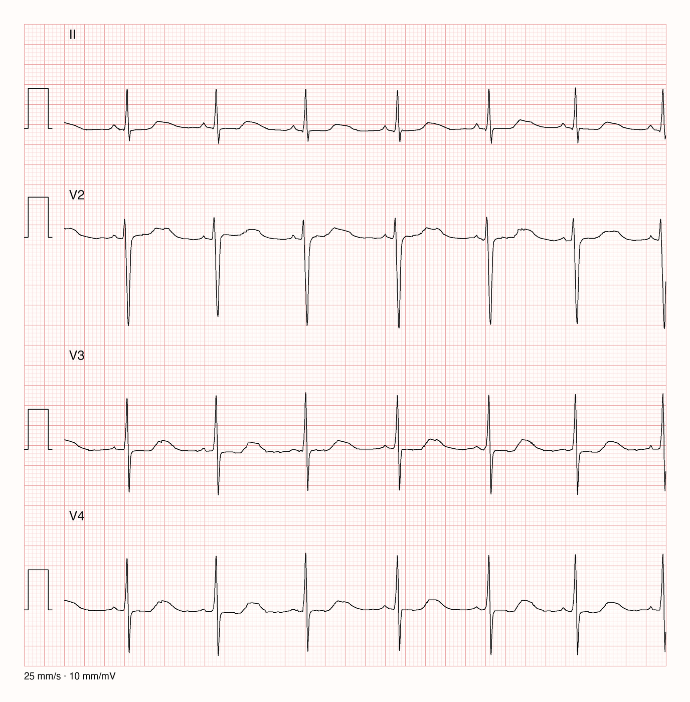 Reales EKG mit den Ableitungen II, V2, V3 und V4 über sechs Sekunden bei 25 mm/s und 10 mm/mV: regelmäßiger Sinusrhythmus mit schmalen QRS-Komplexen; die T-Wellen sind niedrig und breit und gehen besonders in V2 und V3 ohne klare Grundlinie in eine zweite flache Welle über.