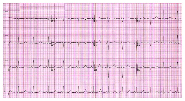 Reales Zwölfkanal-EKG mit Rhythmusstreifen II: regelmäßiger Rhythmus um 70/min mit P-Welle vor jedem schmalen QRS-Komplex. Nach dem QRS-Komplex verläuft die Linie lange flach, erst spät folgt eine normal geformte, positive T-Welle; der Abstand vom QRS-Beginn bis zum T-Ende ist dadurch lang.