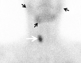 Planare Szintigrafie von Hals und oberem Thorax von vorn, Spätaufnahme: Ein kleiner, dunkler, rundlicher Speicherherd liegt in der rechten Halsseite in Höhe der Schilddrüse (weißer Pfeil). Weiter oben im Kieferbereich drei schwächere Mehranreicherungen (schwarze Pfeile).