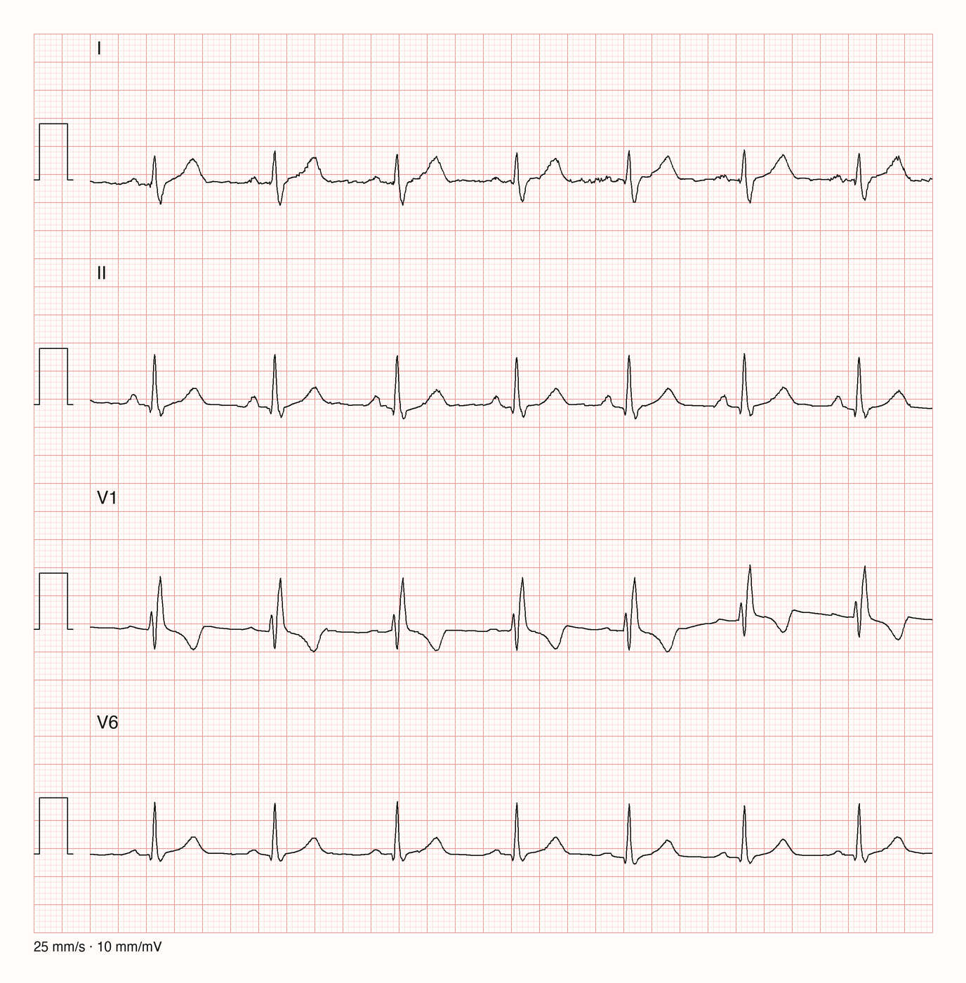 Reales EKG mit den Ableitungen I, II, V1 und V6 über sechs Sekunden bei 25 mm/s und 10 mm/mV: regelmäßiger Rhythmus mit einer P-Welle vor jedem QRS-Komplex; in V1 besteht der QRS-Komplex aus einem kleinen und einem höheren positiven Ausschlag, in I und V6 endet er mit einer breiten S-Zacke.