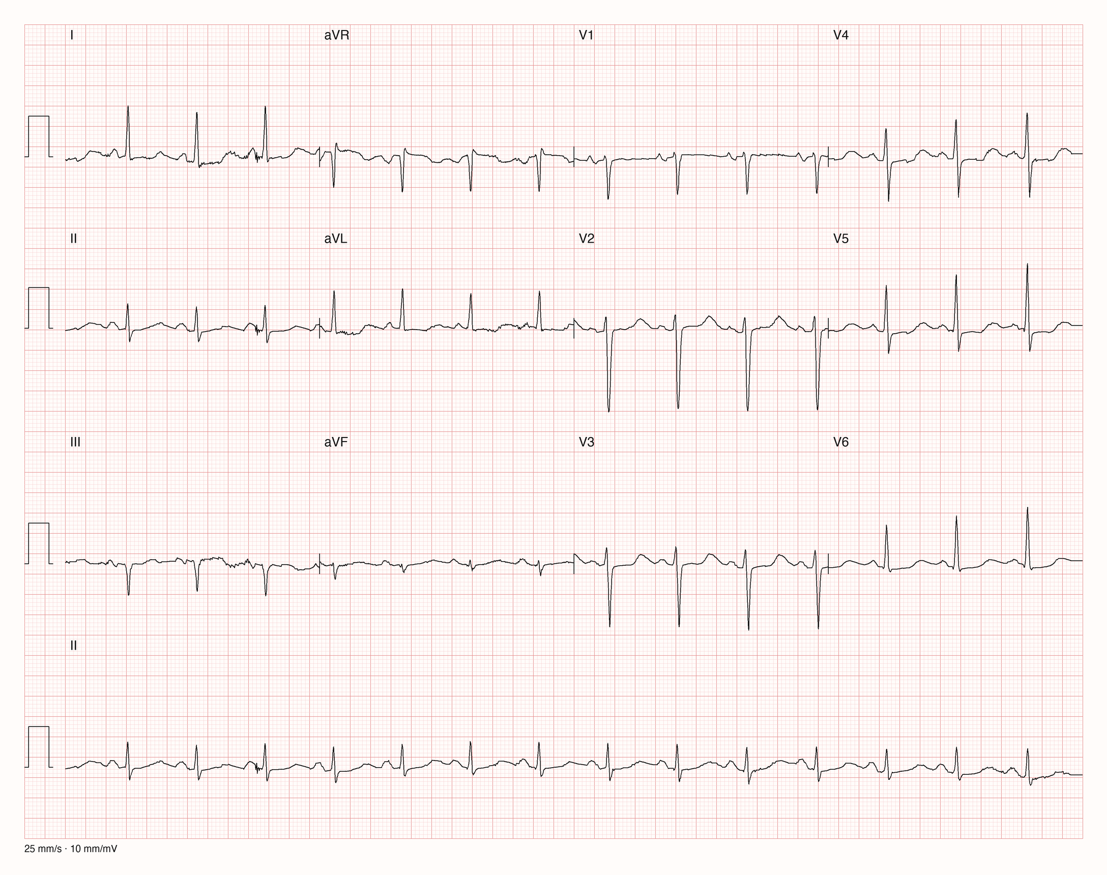 Reales Zwölfkanal-EKG mit Rhythmusstreifen II und Kalibrierung 25 mm/s sowie 10 mm/mV; das Beispiel wird im folgenden Text systematisch erklärt.