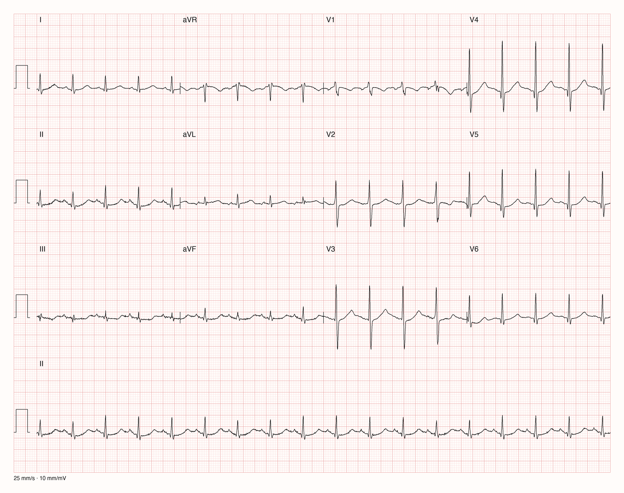 Reales Zwölfkanal-EKG mit den Brustwandableitungen V1 bis V6 und einem langen Rhythmusstreifen II; die Messung soll an gut abgrenzbaren Komplexen erfolgen.