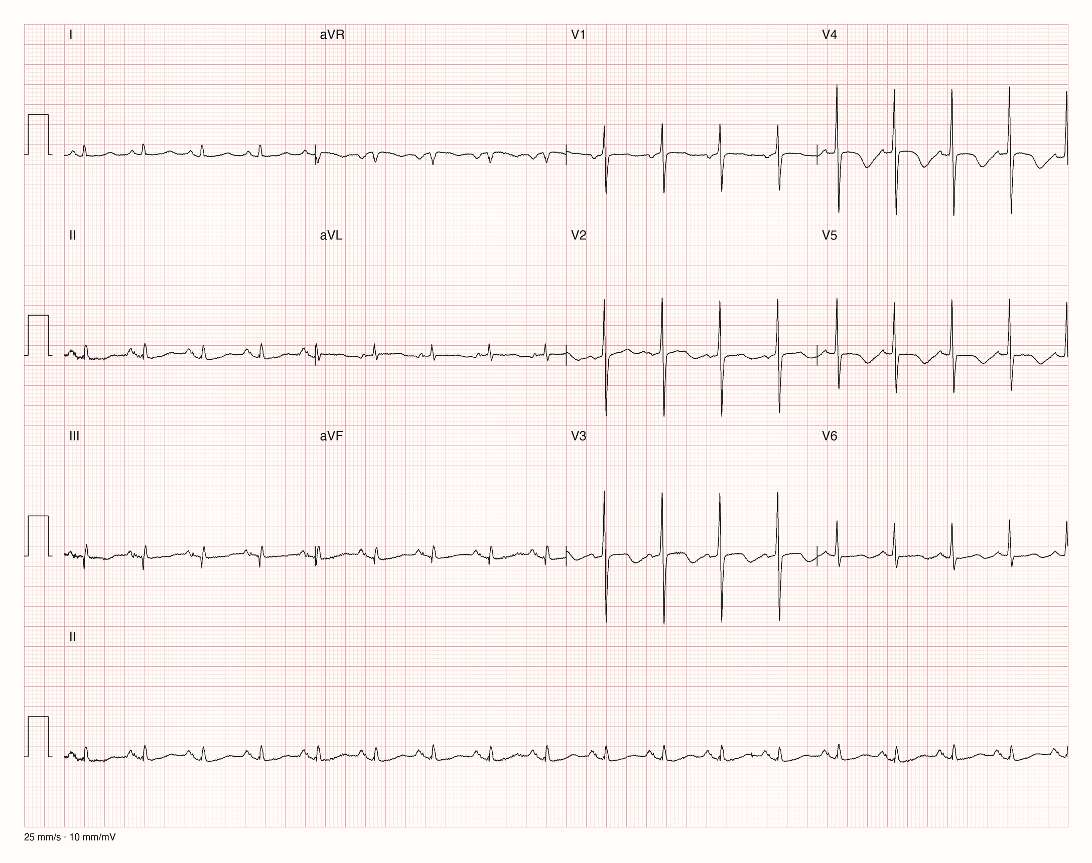 Reales Zwölfkanal-EKG mit Brustwandableitungen V1 bis V6 und langem Rhythmusstreifen II.