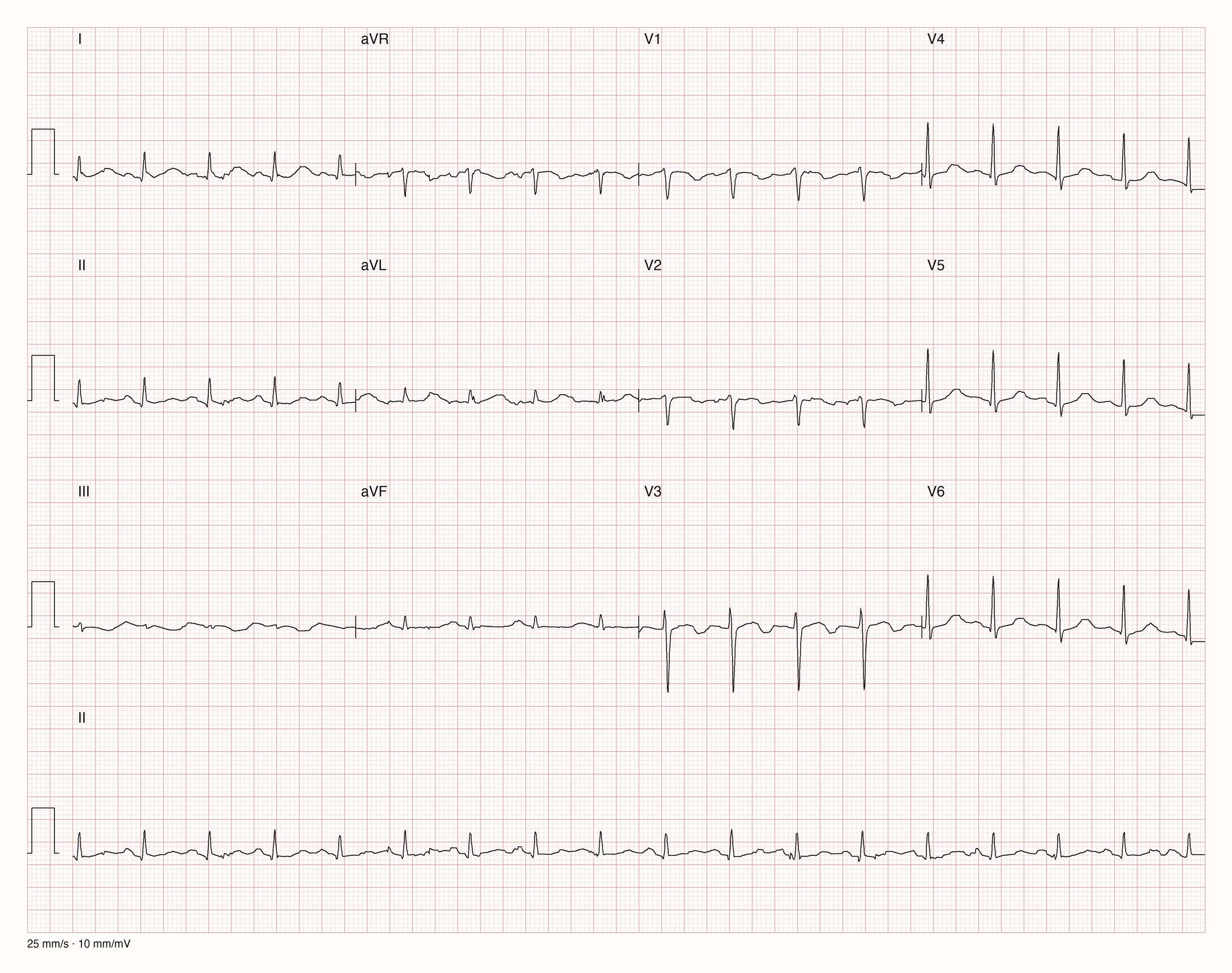 Reales Zwölfkanal-EKG mit zehnsekündigem Rhythmusstreifen II; für den Formelvergleich sind QT 0,37 s und RR 0,57 s als gerundete Rechenwerte vorgegeben.