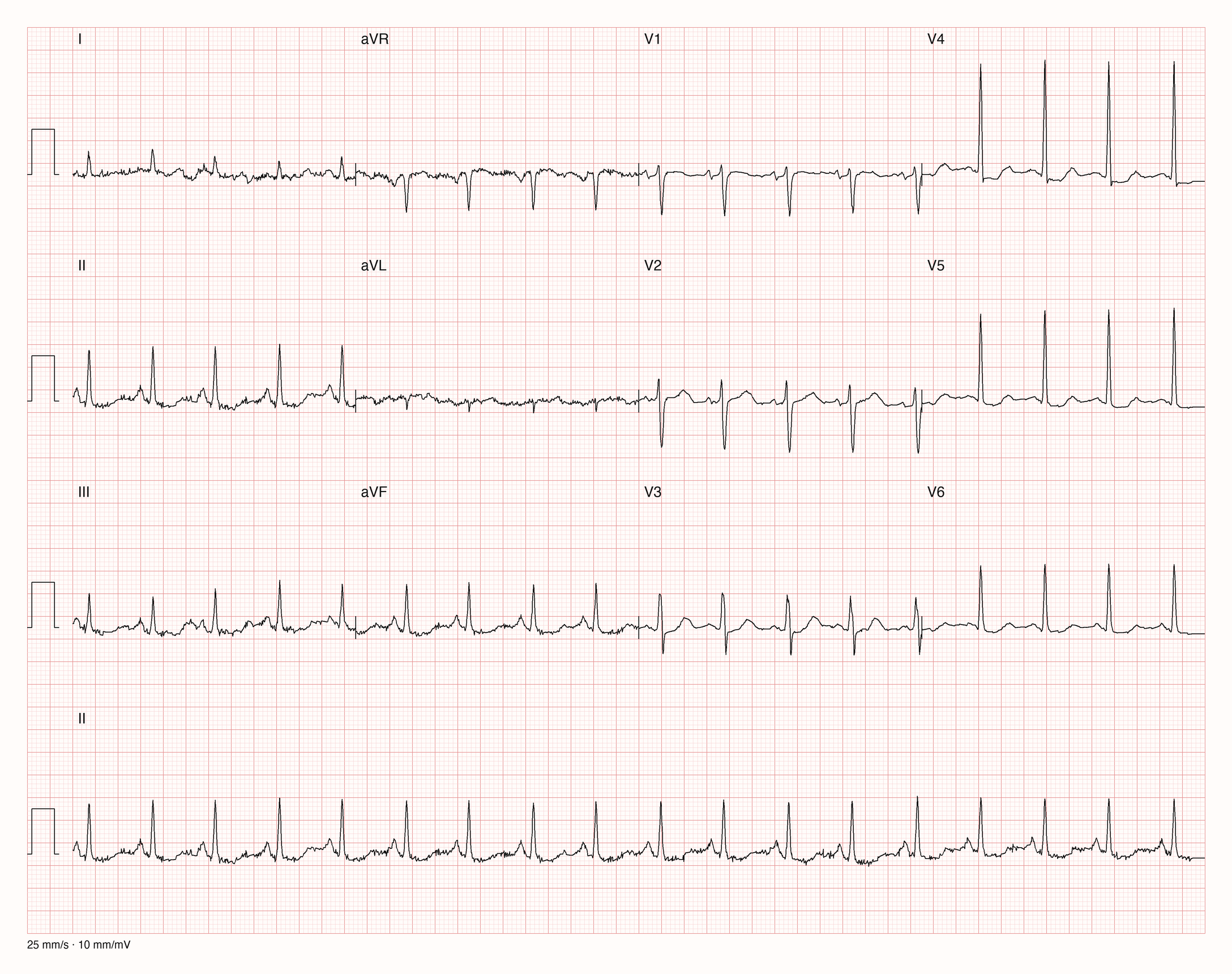 Reales Zwölfkanal-EKG mit sichtbaren Störanteilen vor allem in den Extremitätenableitungen und im Rhythmusstreifen II; die Brustwandableitungen sind vergleichend zu prüfen.