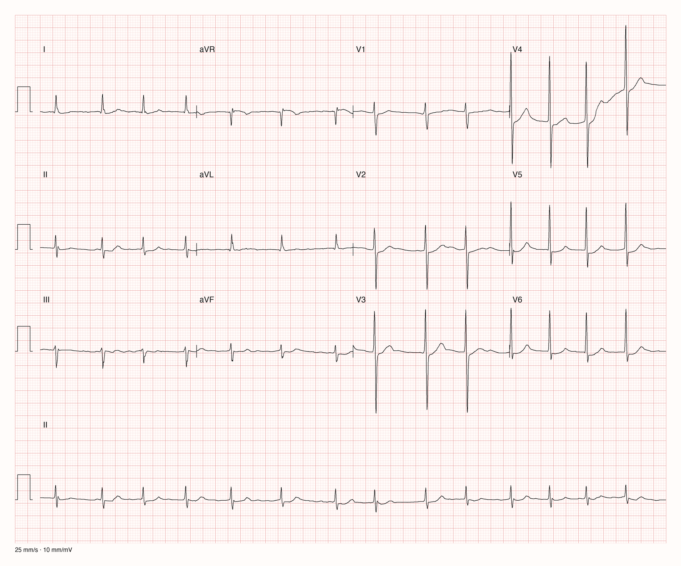 Reales Zwölfkanal-EKG mit langem Rhythmusstreifen II; die Grundlinie in V4 verändert sich im Verlauf deutlich.