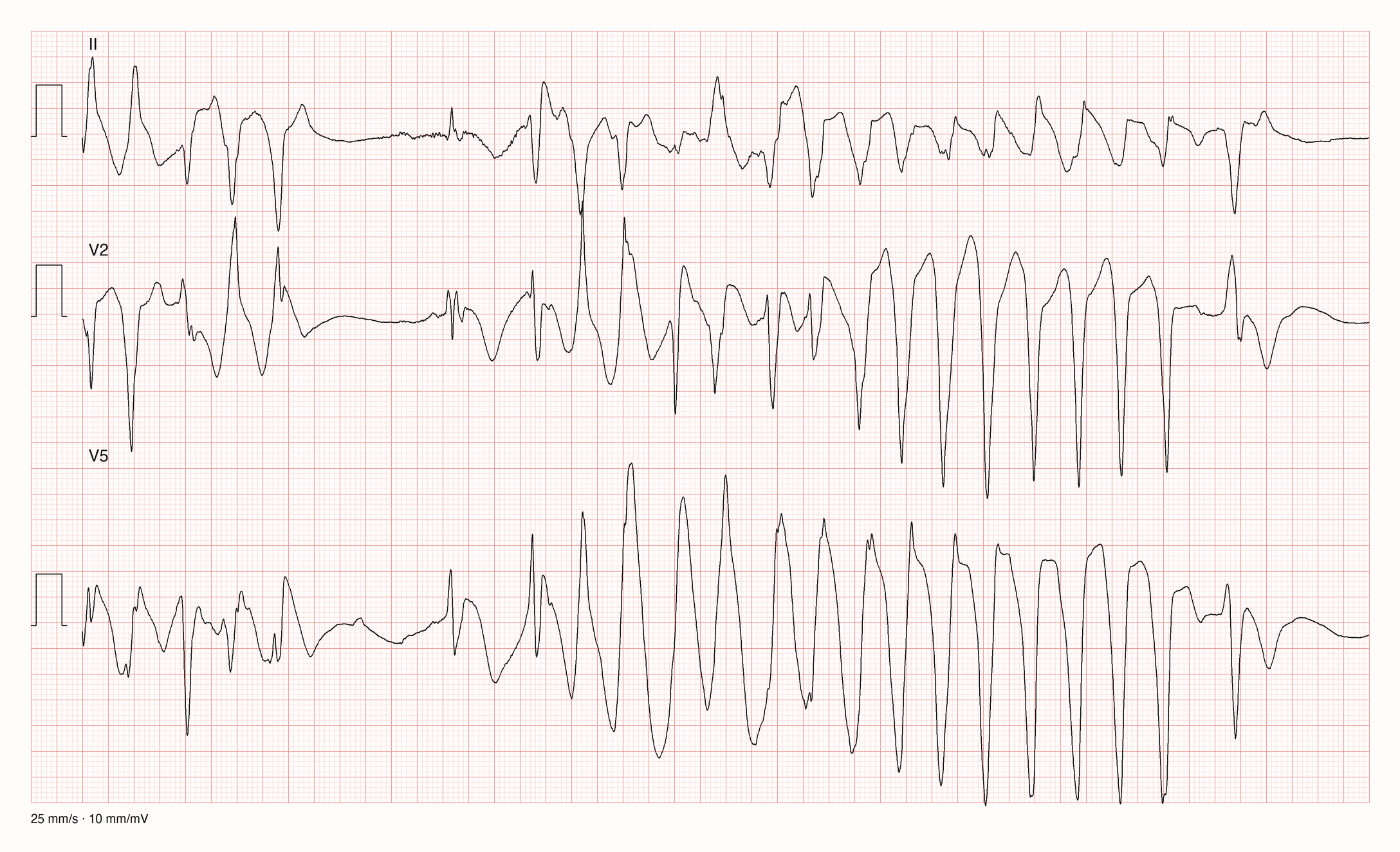 Reales EKG mit den Ableitungen II, V2 und V5 über zehn Sekunden bei 25 mm/s und 10 mm/mV: zu Beginn einige breite, unterschiedlich geformte Kammerkomplexe, dann eine kurze Pause und ein Einzelschlag; danach eine schnelle Folge breiter Ausschläge, die in V5 spindelförmig größer und wieder kleiner werden und in V2 die Richtung wechseln. Gegen Ende des Streifens hört die Salve auf.