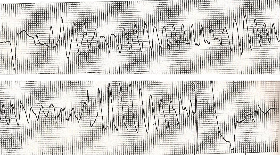 Realer Monitorstreifen der Ableitung II in zwei aufeinanderfolgenden Abschnitten untereinander: nach einem Eigenschlag eine schnelle, breite Kammertachykardie, deren Ausschläge spindelförmig größer und kleiner werden und die Richtung wechseln. Im unteren Abschnitt rechts ein steiler Schockartefakt, danach kehrt ein langsamer Eigenrhythmus zurück.