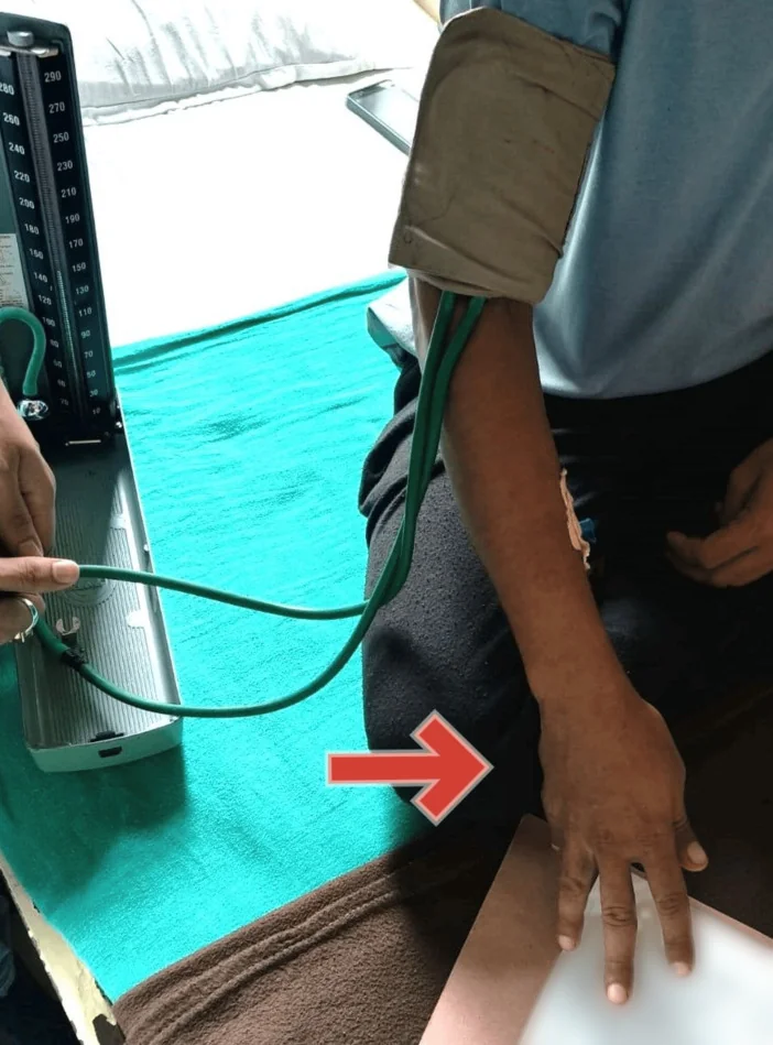 Foto einer Untersuchung im Sitzen: Am Oberarm liegt eine aufgepumpte Blutdruckmanschette, links ist das Quecksilbermanometer zu sehen. Ein roter Pfeil zeigt auf die Hand desselben Arms, die eine Beugehaltung einnimmt.