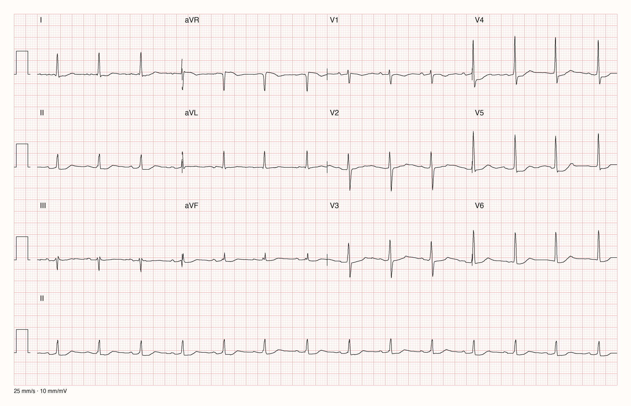 Reales Zwölfkanal-EKG mit Rhythmusstreifen II bei 25 mm/s und 10 mm/mV: regelmäßiger Rhythmus um 85/min mit P-Wellen vor schmalen QRS-Komplexen; die T-Wellen sind in den Extremitätenableitungen und in V4 bis V6 niedrig und flach, die ST-Strecke ist in V4 bis V6 leicht gesenkt.