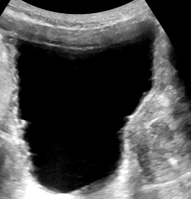Sonografie der Harnblase eines älteren Mannes: Die Blase ist groß und echofrei gefüllt, ihre Wand ist unregelmäßig verdickt und gebuchtet.