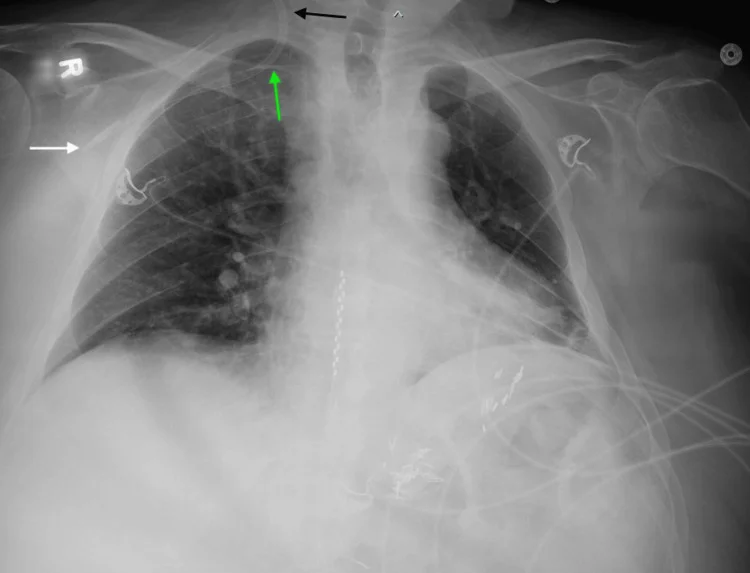 Röntgen-Thorax als Bettaufnahme im Sitzen nach Anlage eines Dialysekatheters über die rechte V. jugularis interna. Ein schwarzer Pfeil markiert den Katheter in der Vene am Hals, ein grüner Pfeil den Abgang in die V. subclavia statt nach kaudal zur oberen Hohlvene, ein weißer Pfeil die Katheterspitze lateral in der V. axillaris.
