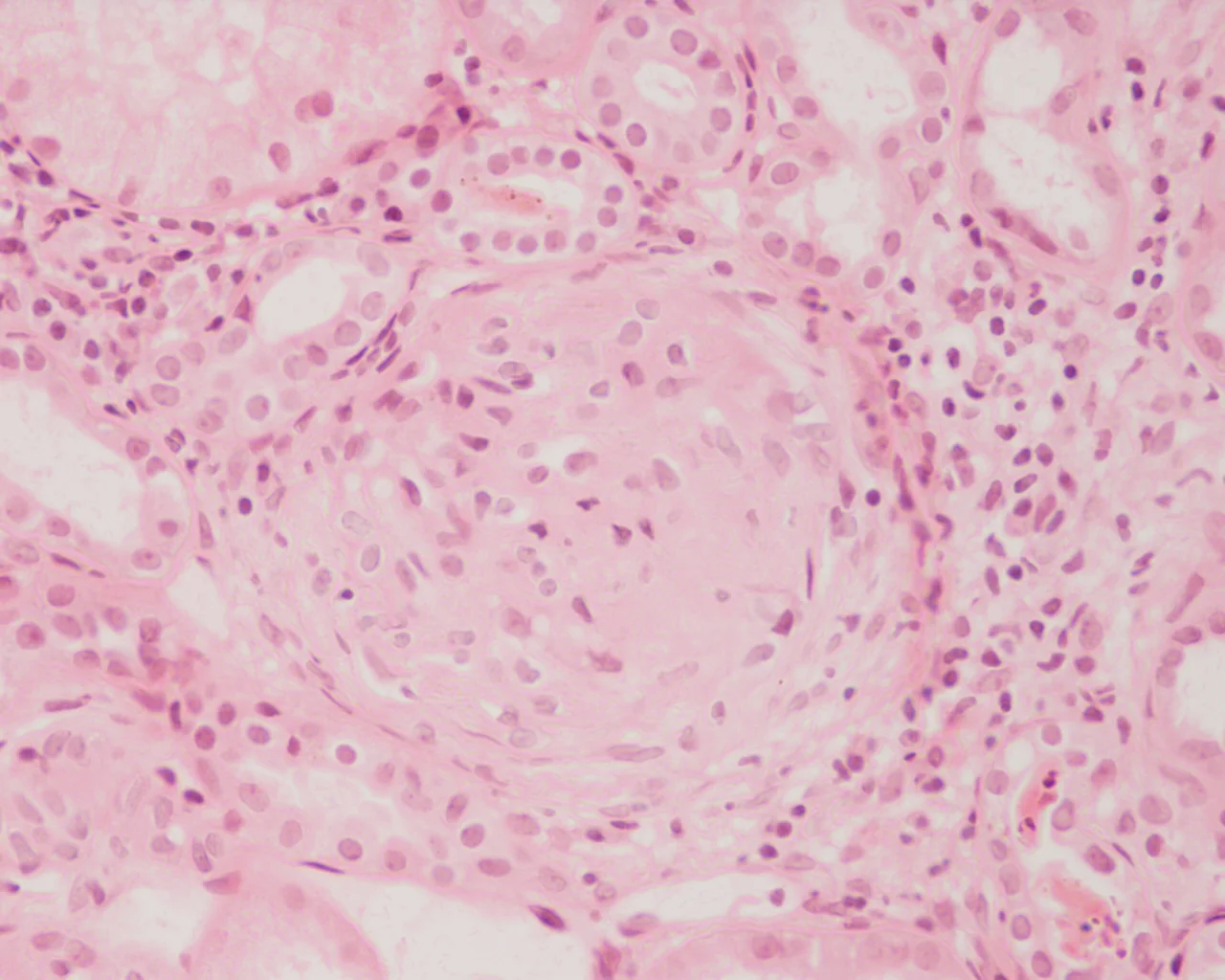 Lichtmikroskopisches Bild eines Glomerulus in Hämatoxylin-Eosin-Färbung: Ein breiter, zellreicher Halbmond füllt den Bowman-Raum und drückt das Kapillarknäuel zusammen; ringsum Tubuli.
