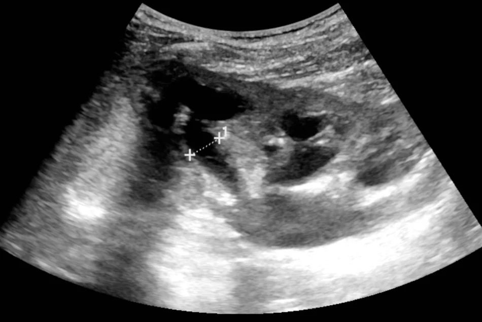 Sonografie einer Niere im Längsschnitt: Nierenbecken und Kelche sind als verbreiterte, schwarze, echofreie Räume erweitert; eine Kelchbreite ist mit zwei Messkreuzen markiert. Das umgebende Parenchym ist verschmälert.
