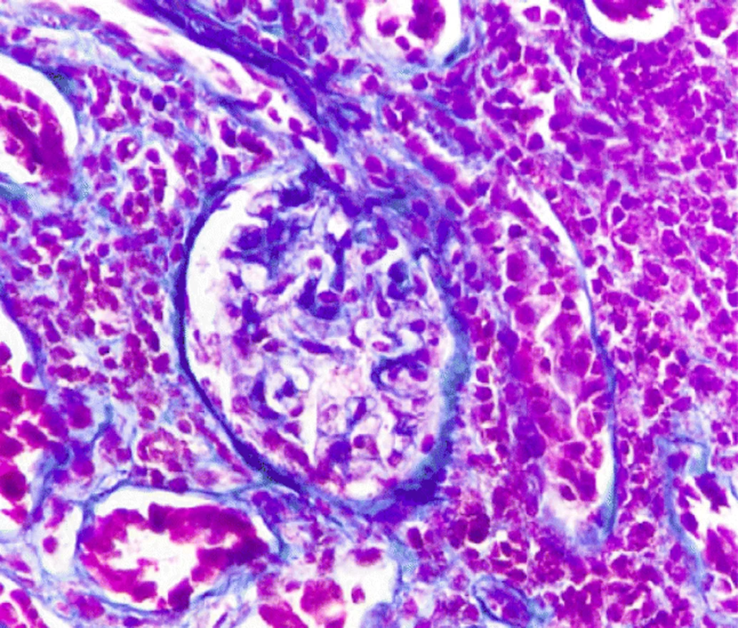 Lichtmikroskopisches Bild einer Nierenbiopsie in Trichromfärbung: In der Mitte ein Glomerulus ohne Zellvermehrung, ringsum Tubuli und ein dichtes Infiltrat aus Entzündungszellen im Interstitium.