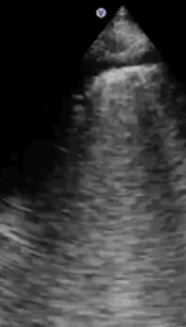 Lungenultraschall mit Sektorschallkopf: Unter der hellen Pleuralinie ziehen mehrere breite, helle, senkrechte Streifen fächerförmig bis an den unteren Bildrand; dazwischen bleiben kaum dunkle Anteile.