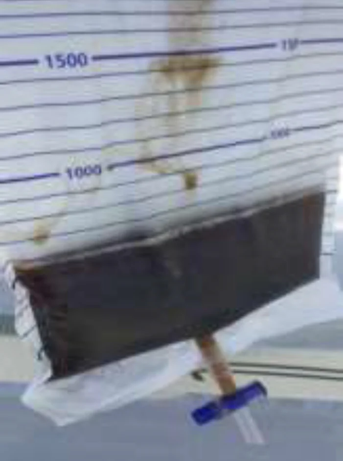 Fotografie eines Urinbeutels mit Skala bis 1.500 ml; im unteren Teil steht dunkelbrauner, fast schwarzer Urin.