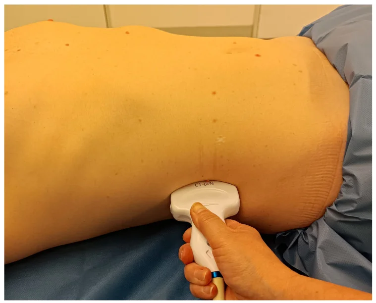 Eine liegende Person mit unbedeckter Flanke; eine Hand hält einen gebogenen Ultraschallkopf längs an die seitliche Flanke unterhalb des Rippenbogens.