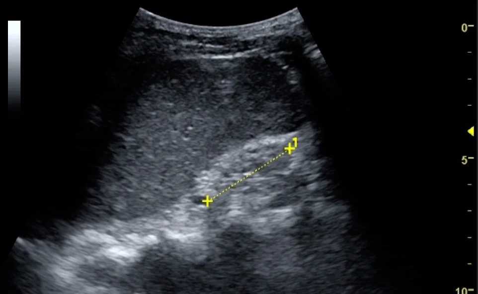 Ultraschall-Längsschnitt einer kleinen, gleichmäßig hellen Niere ohne erkennbare Grenze zwischen Parenchym und zentralem Sinus. Eine gelbe gepunktete Linie zwischen zwei Kreuzen misst die verkürzte Länge.
