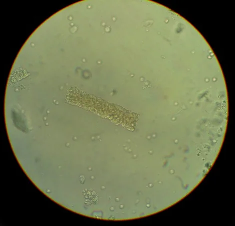 Ungefärbtes Urinsediment im runden Mikroskopsichtfeld: In der Mitte liegt ein länglicher Körper mit parallelen Rändern, dicht gefüllt mit kleinen runden, gelblichen Zellen; ringsum einzelne kleine runde Zellen und Partikel.