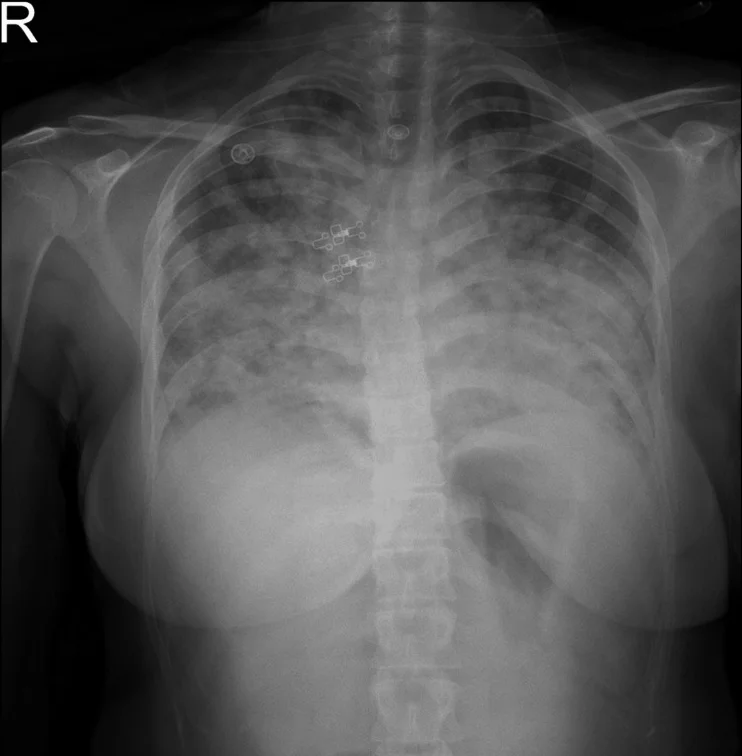 Röntgenaufnahme des Thorax von vorn mit Seitenmarkierung R: In beiden Lungen liegen ausgedehnte fleckige, teils zusammenfließende Verschattungen, betont in den mittleren und unteren Feldern; EKG-Elektroden sind sichtbar.