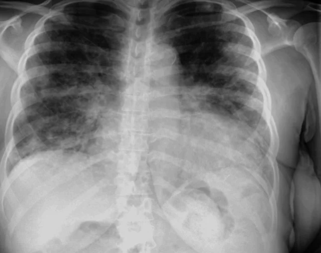Röntgenaufnahme des Thorax im Sitzen von vorn: In beiden Lungen, betont in Mittel- und Unterfeldern, liegen ausgedehnte fleckige bis zusammenfließende Verschattungen; die Oberfelder sind dunkler und besser belüftet.