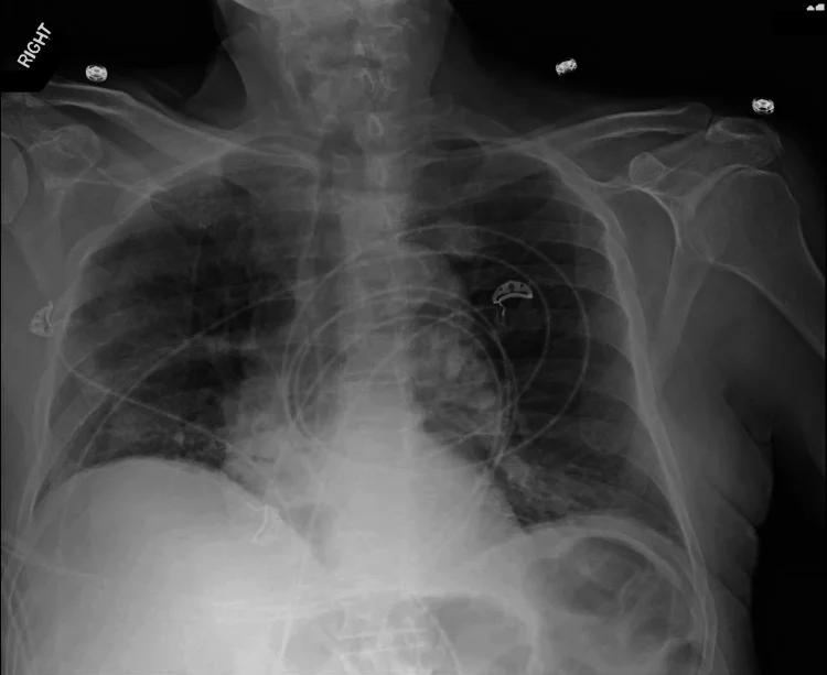 Röntgenaufnahme des Thorax im Liegen mit Seitenmarkierung RIGHT, EKG-Elektroden und Kabeln: Beidseits ist die Lungenzeichnung vermehrt, unscharf und fleckig-netzig; die Zwerchfellkonturen sind teils verwischt.