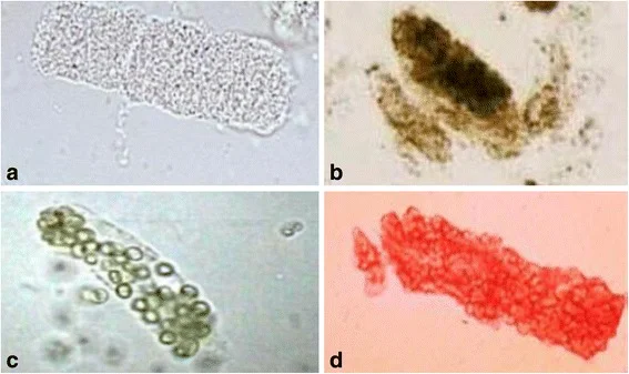 Vier Mikroskopiefelder aus dem Urinsediment, mit a bis d beschriftet: a ein heller, gleichmäßig feinkörniger Zylinder aus Tubulusepithelzellen, b ein dunkelbrauner, grob granulierter Zylinder, c ein Zylinder mit eingeschlossenen runden Leukozyten, d ein rötlicher Zylinder dicht gepackt mit Erythrozyten.