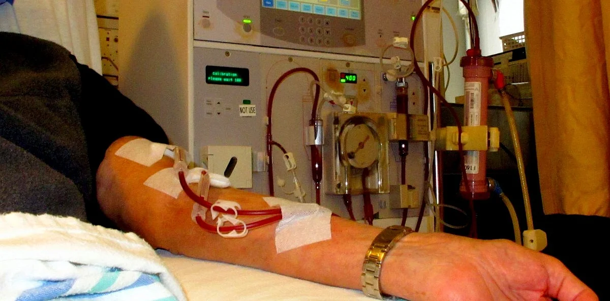 Unterarm eines Patienten während der Hämodialyse: zwei mit Pflaster fixierte Dialysenadeln in der Fistelvene, rote Blutschläuche führen zum Dialysegerät mit Blutpumpe.