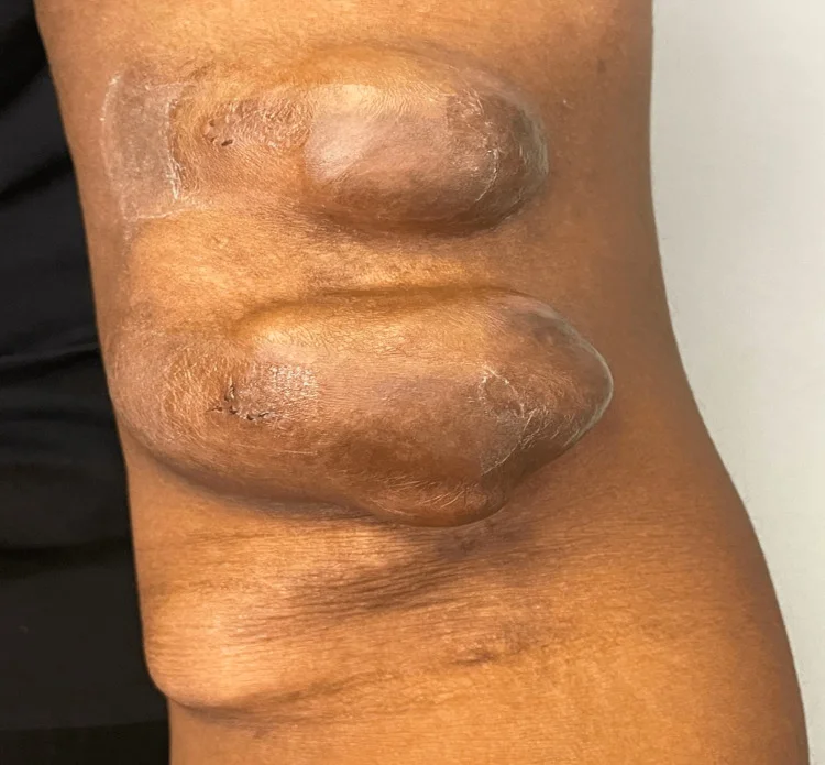 Arm mit AV-Fistel von vorn: zwei große, glänzende, vorgewölbte Abschnitte im Fistelverlauf mit einzelnen kleinen Punktionsnarben, darunter ein dritter, flacherer Buckel.
