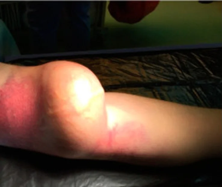 Arm mit großem, vorgewölbtem Aneurysma einer Oberarmfistel (brachiozephal); die Haut darüber ist gespannt, glänzend und gerötet.