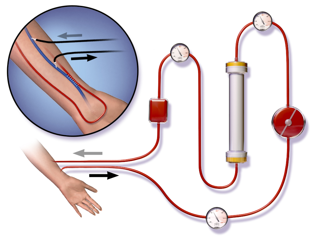 Zeichnung einer Hämodialyse: Aus einer Unterarm-AV-Fistel fließt Blut über Schläuche mit Pumpe und Druckmessern durch den Dialysator und kehrt über eine zweite Nadel in die Fistelvene zurück.