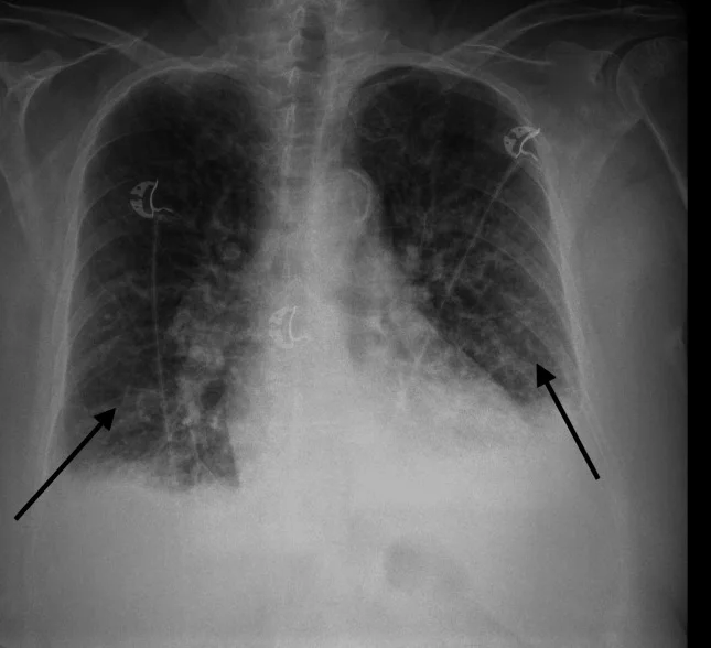 Thorax-Röntgenbild in a.-p.-Projektion: beidseits vermehrte, netzartige Lungenzeichnung, unscharfe Hili, basal beidseits flächige Verschattungen mit verstrichenen Zwerchfellwinkeln; zwei schwarze Pfeile zeigen auf die Unterfelder.