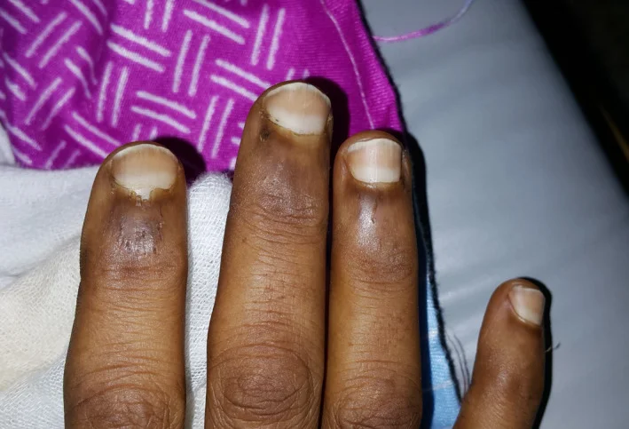 Vier Finger mit Nägeln, deren proximale Hälfte weißlich und deren distaler Rand scharf begrenzt rotbraun ist.