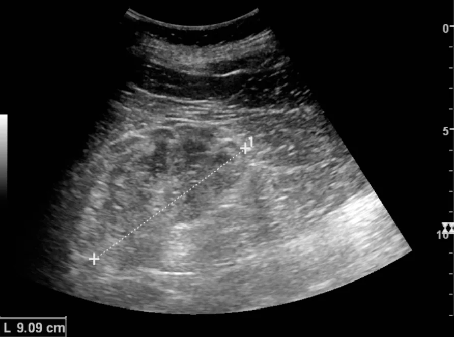 Ultraschall-Längsschnitt einer Niere mit echoreichem Parenchym und schmaler Rinde; eine Messlinie zeigt die Nierenlänge von 9,09 cm.