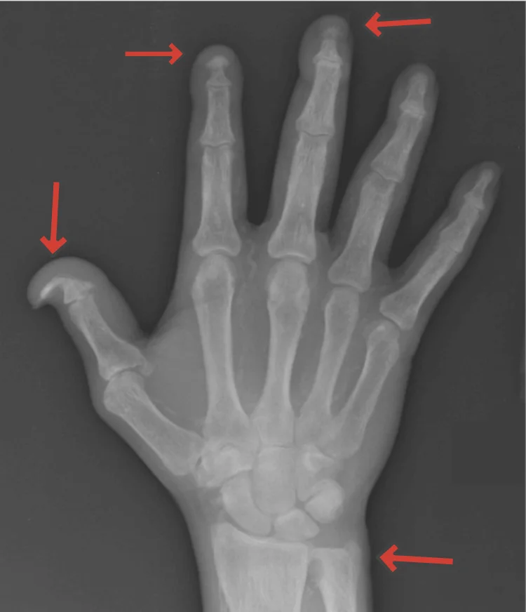 Röntgenaufnahme einer rechten Hand; rote Pfeile zeigen auf aufgelöste Endglieder mehrerer Finger und auf das distale Ulnaende.