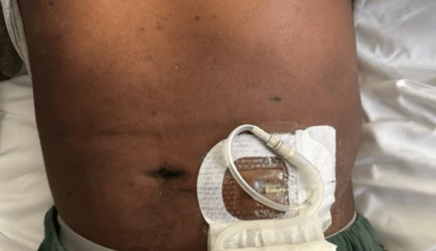 Bauch eines liegenden Patienten von vorn: neben dem Nabel tritt ein dünner Katheter aus der Haut, unter einem durchsichtigen Pflasterverband in einer Schlinge fixiert; das Schlauchende ist in eine Kompresse eingewickelt.