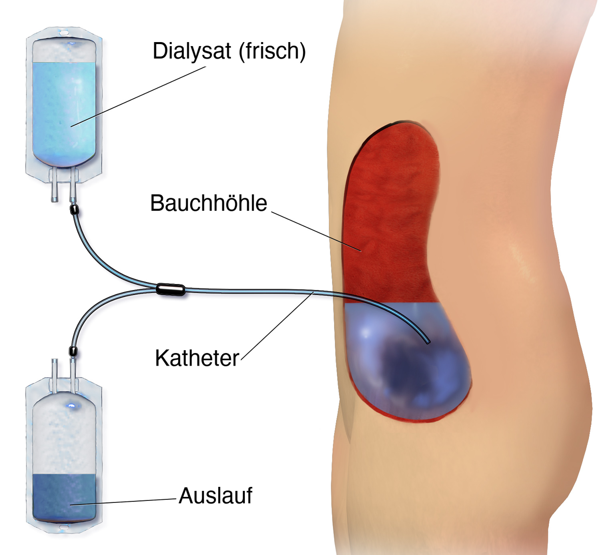 Zeichnung eines Patienten im Profil: Ein Katheter führt aus der Bauchhöhle zu einem Beutel mit frischem Dialysat und zu einem Auslaufbeutel; das Dialysat sammelt sich im unteren Bauchraum.