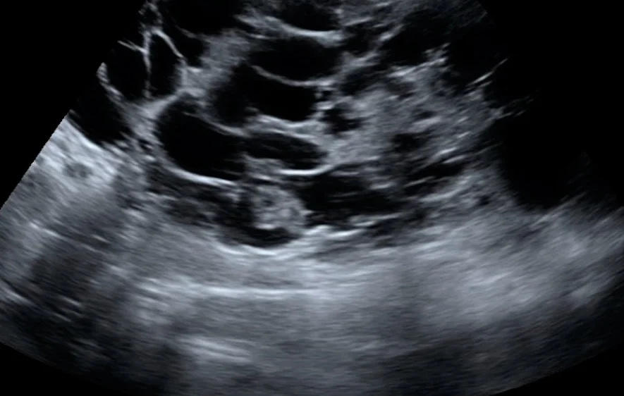 Ultraschall-Längsschnitt einer vergrößerten Niere, deren Parenchym fast vollständig durch zahlreiche echofreie, rundliche Zysten mit dünnen echoreichen Septen ersetzt ist.