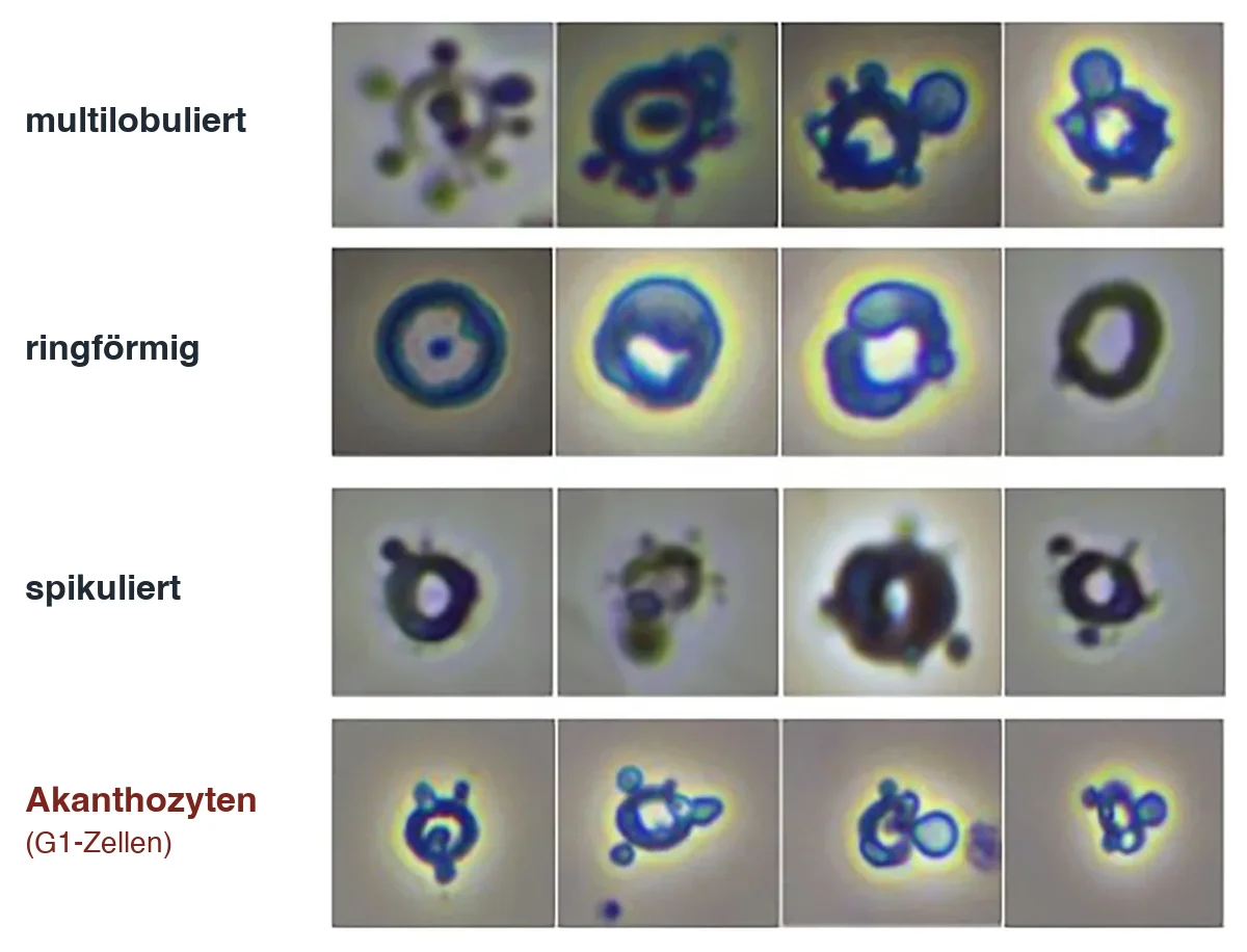 Phasenkontrastmikroskopie, 400-fach: vier Reihen dysmorpher Erythrozyten aus dem Urin, nämlich multilobuliert, ringförmig, spikuliert und in der untersten Reihe Akanthozyten mit Ring und bläschenartigen Ausstülpungen.