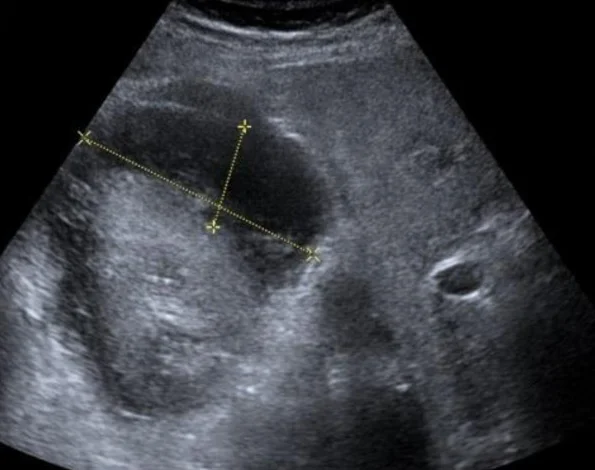 Ultraschallbild der Niere nach Biopsie: Über dem Nierenrand liegt eine große, dunkle, sichelförmige Flüssigkeitsansammlung unter der Kapsel; zwei gelbe Messlinien markieren ihre Ausdehnung.