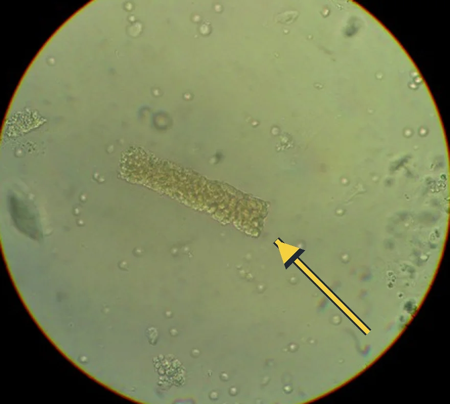 Lichtmikroskopisches Gesichtsfeld eines Urinsediments: ein länglicher Zylinder, dicht gefüllt mit eingebetteten Erythrozyten, markiert durch einen gelben Pfeil.