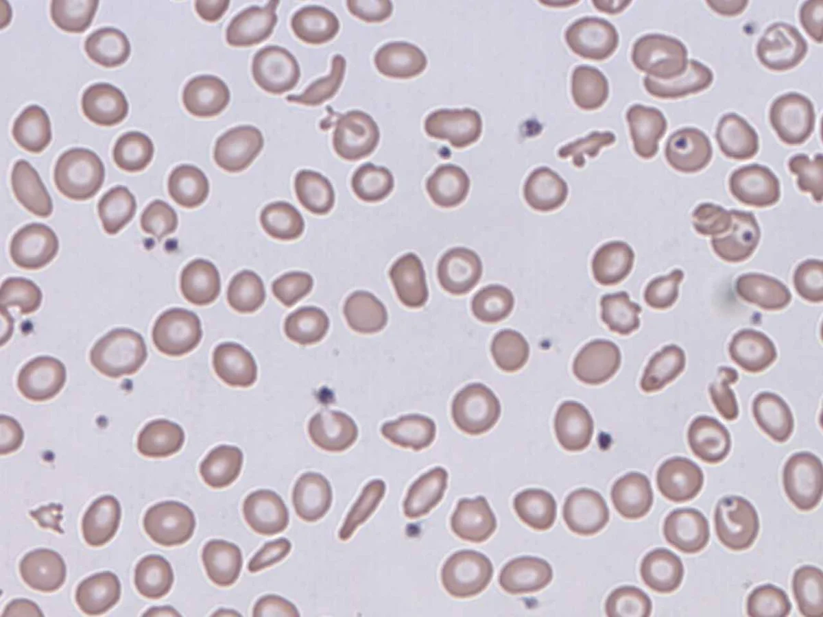 Blutausstrich mit überwiegend runden roten Blutkörperchen; dazwischen kleinere, eckige, helm-, sichel- und dreiecksförmige Erythrozytenbruchstücke sowie einzelne Thrombozyten.