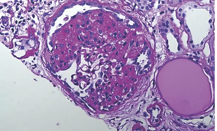 PAS-gefärbte Nierenbiopsie: ein Glomerulus, in dem ein Teil des Kapillarknäuels verdichtet und vernarbt ist, während einzelne Schlingen offen bleiben; rechts ein Tubulus mit homogenem rosafarbenem Eiweißzylinder.